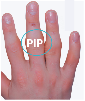 PIP early stiffness image